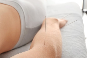 Therapy of female arm with pricking acupuncture needle - obrazy, fototapety, plakaty