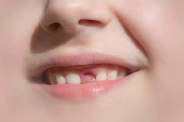 Child's smile without anterior front tooth. Children's dentistry and health