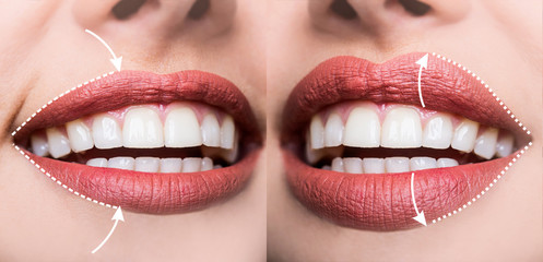Contour plastic, augmentation of the lips, filling wrinkles, changing shape volume of lips, rejuvenating upper lip. Injections of hyaluronic acid for sexy lips. Beauty Salon or Plastic Surgeon - obrazy, fototapety, plakaty
