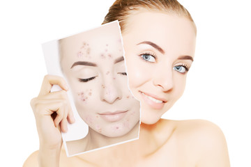 young gorgeous woman with perfect skin releases her face from pimples
