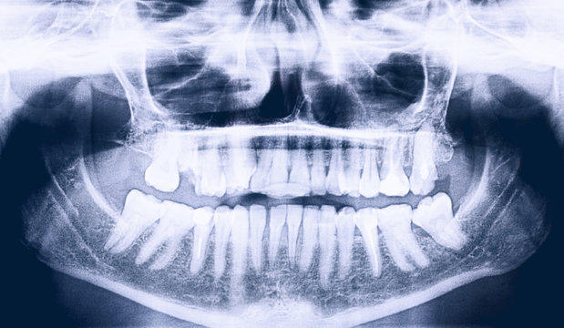 Close Up panoramic dental X Ray image.