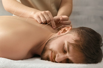 Young man getting acupuncture treatment, closeup - obrazy, fototapety, plakaty