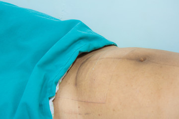 Cesarean Section wound on woman abdominal