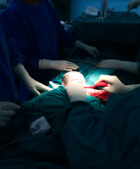 Birth surgery with Cesarean Section