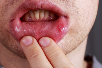 Stomatitis on the lips