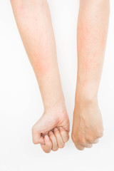 Rash allergy from touching arms ,eczema, Dermatitis
