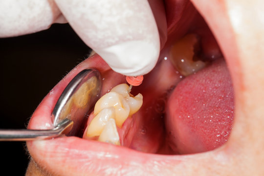 Endodontic Procedure Close Up