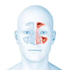 Paranasal sinusitis, medical illustration