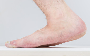 Men's right leg with severe symptoms of diseases of the feet.