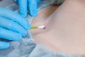 Operation to install microdermal piercing