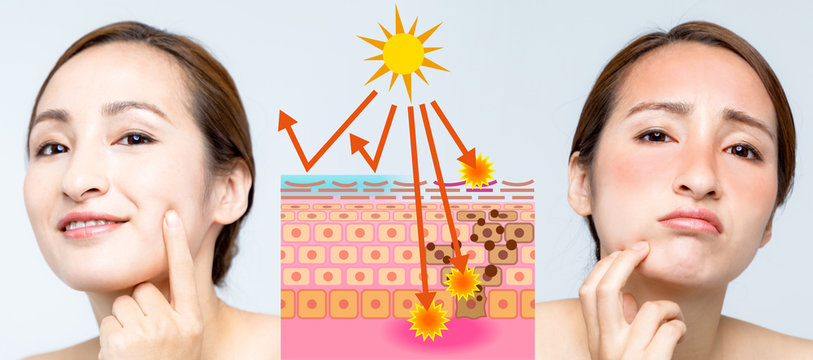 woman using sunscreen and woman getting sunburned. before after image.