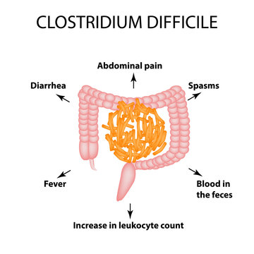 Clostridium difficile. Pathogenic flora. The bacterium causes intestinal diseases. Symptoms of infection. Infographics. Vector illustration.