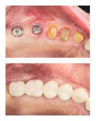 before and after  : implants and crowns