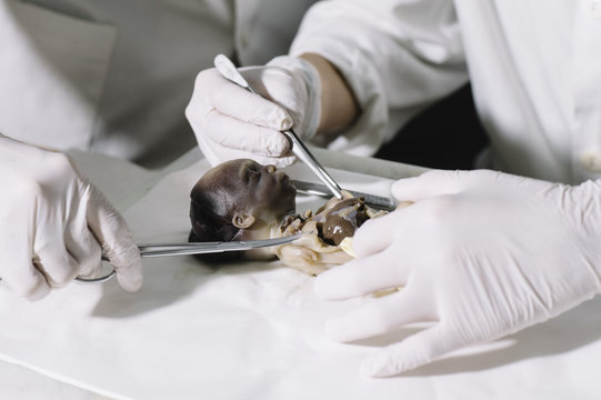 Medics preparing dead fetus