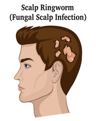 Illustration of Scalp Ringworm