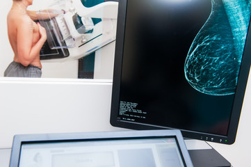 Mammogram snapshot of breasts of a female patient on the monitor with undergoing mammography test...