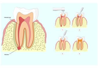 dental abscess or granuloma