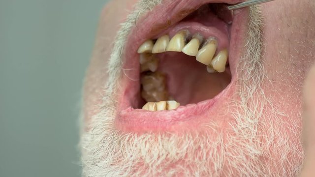 Bad teeth close up. Dental examination procedure. Symptoms of caries.