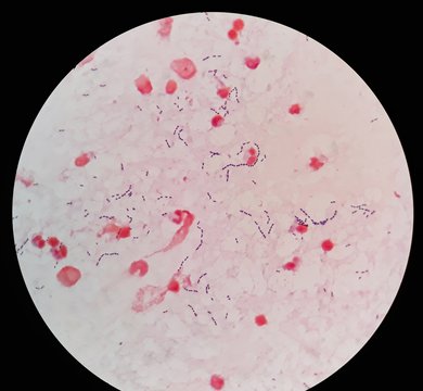 Smear of human blood culture Gram's stained with gram positive cocci in chain bacteria, under 100X light microscope. (Selective focus)
