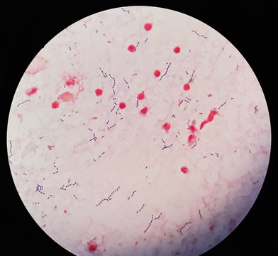 Smear of human blood culture Gram's stained with gram positive cocci in chain bacteria, under 100X light microscope. (Selective focus)