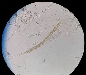 Parasite in stool under 40X light microscopy; Strongyloides stercoralis is a human pathogenic parasitic roundworm causing the disease strongyloidiasis. Its common name is threadworm.
