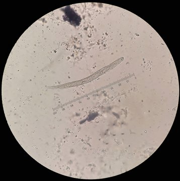 Parasite in stool under 40X light microscopy; Strongyloides stercoralis is a human pathogenic parasitic roundworm causing the disease strongyloidiasis. Its common name is threadworm.