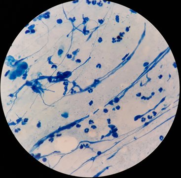 Smear of Acid-Fast bacilli (AFB) stained from sputum specimen, under 100X light microscope.