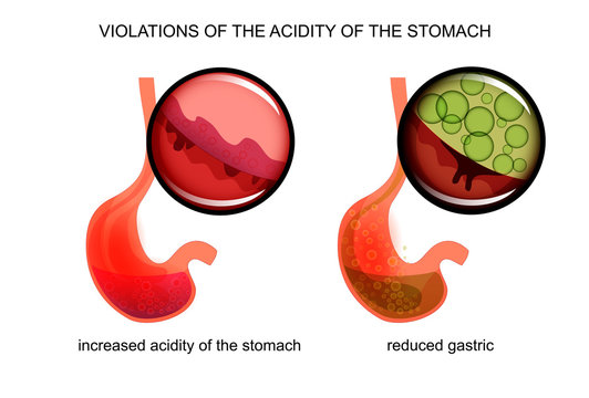 high and low acidity of the stomach