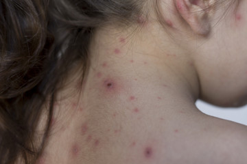 little girl with illness varicella close up