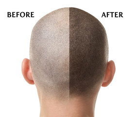 Hair loss concept. Head of man on white background, closeup