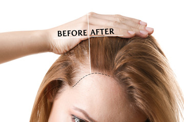 Woman before and after hair loss treatment on white background