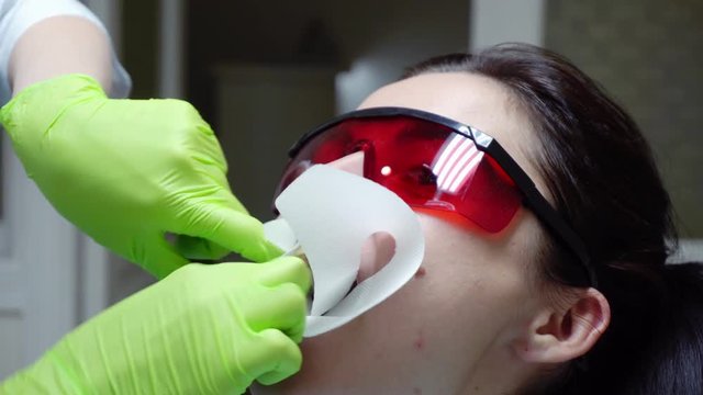 Closeup view of the dentist's hands putting rubber dam in a mouth of a female patient. Shot in 4k