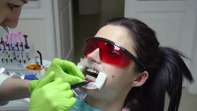 Young woman with an expander in mouth at the dental clinic. Application of protective whitening gel to the teeth. Modern dental office. Shot in 4k