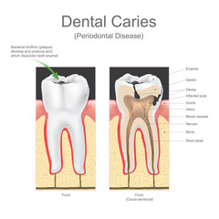 Dental caries periodontal disease.