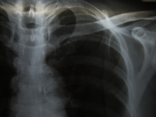  Chest x-ray show alveolar infiltration