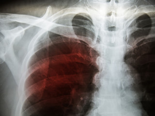 Pulmonary Tuberculosis ( TB ) : Chest x-ray show alveolar infiltration
