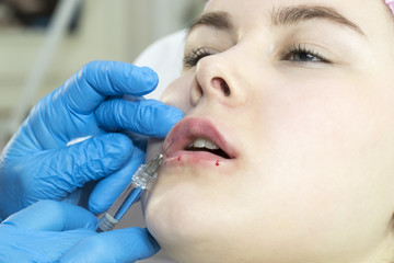 The process of cosmetic surgery of water injection in the area of the lips of a woman 