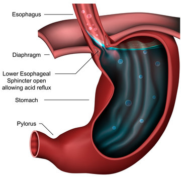 Stomach and esophagus with gastric reflux injury, vector illustration