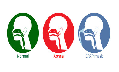 Vector illustration of normal breathing, with apnea disease and with CPAP mask. 