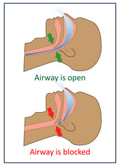 Vector illustration of normal breathing and with apnea symptoms.