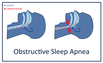 Vector illustration of obstructive sleep apnea.