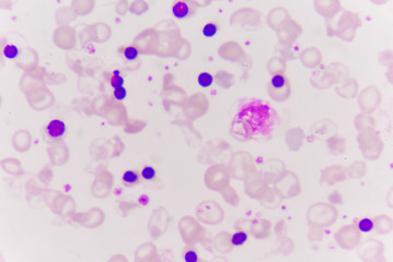Abnormal red blood cells