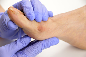 Foot with a bunion
