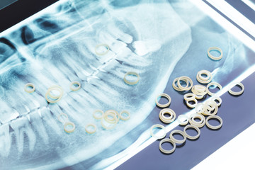 Jaw xray and orthodontic latex rings for braces