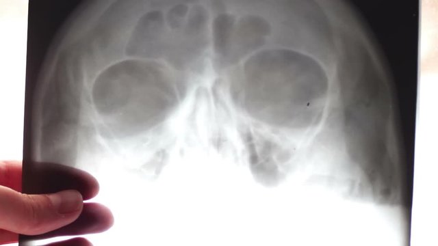 Doctor looks at the X-ray of the human skull and maxillary sinuses