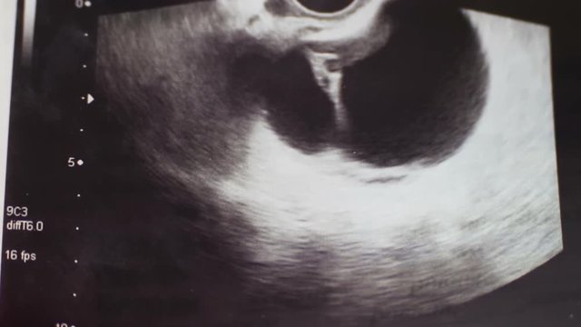 Close up of Medical ultrasound photo,female ovary with the pathology of the left ovarian cyst, emergency surgery in hospital