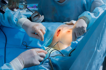 Surgeons team working with Monitoring of patient in surgical operating room. close-up breast...