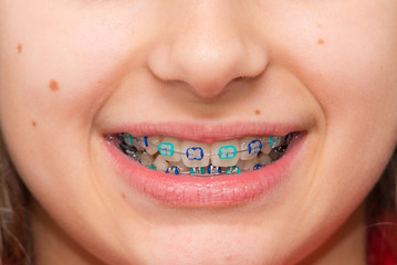 Stock photo of the metal braces