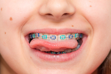 Stock photo of the metal braces