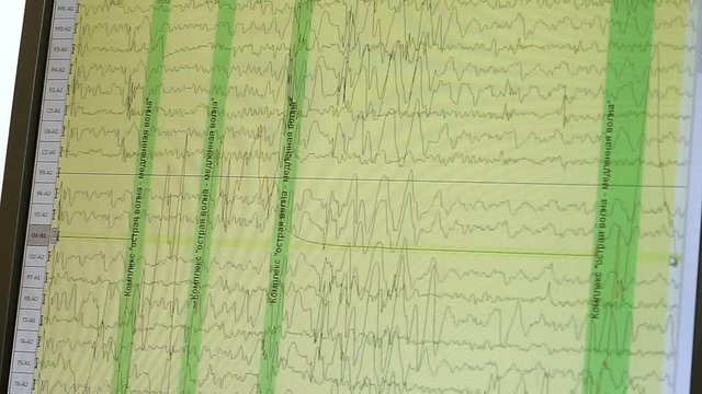 Electroencephalographic examination. Close-up shot of monitor screen with results of monitoring the functions of the human brain. HD